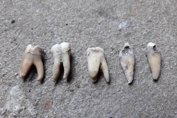 Laudo poderá apontar a idade ou quanto tempo os dentes estavam no local, em Ibirubá