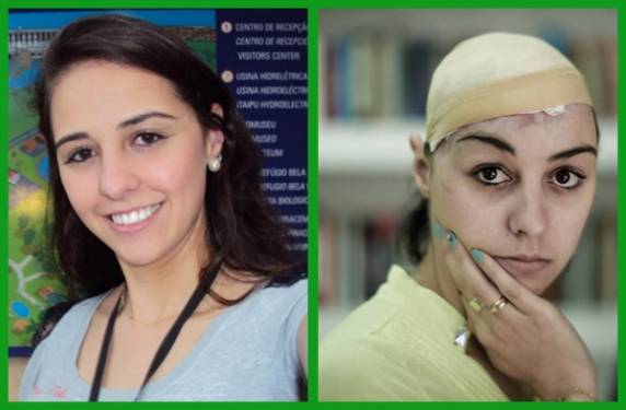 Fernada Dryer, antes e depois do acidente