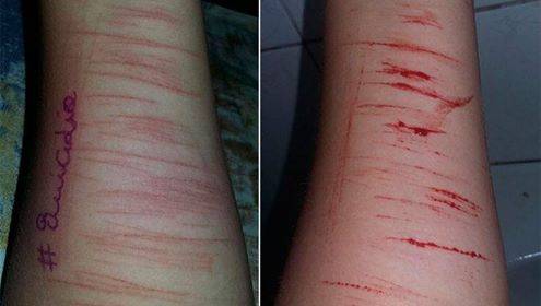 Menina de 

apenas 12 anos foi encontrada com os braços automutilados e com a escrita "#suicídio"