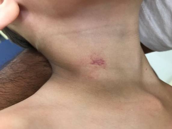 De acordo com familiar, criança disse que marcas no pescoço foram feitas por 

professor, que negou agressão e fez BO contra pai do aluno