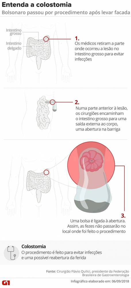 Bolsonaro teve grave perfuração no
intestino grosso e fez colostomia; entenda - foto 2