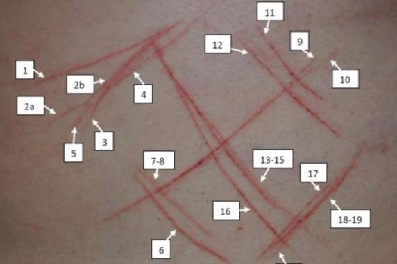 Laudo pericial atesta lesões 

superficiais, traços uniformes e sem evidências de ter havido reação da vítima