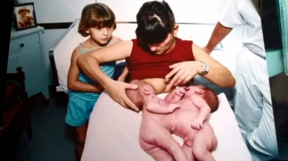 Gêmeos siameses que nasceram unidos pela barriga completam 20 anos em SC - foto 3